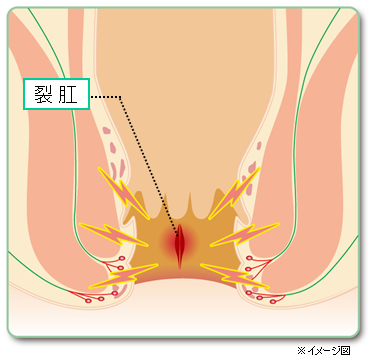 切れ痔