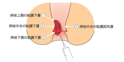 日帰り手術、ジオン注射について